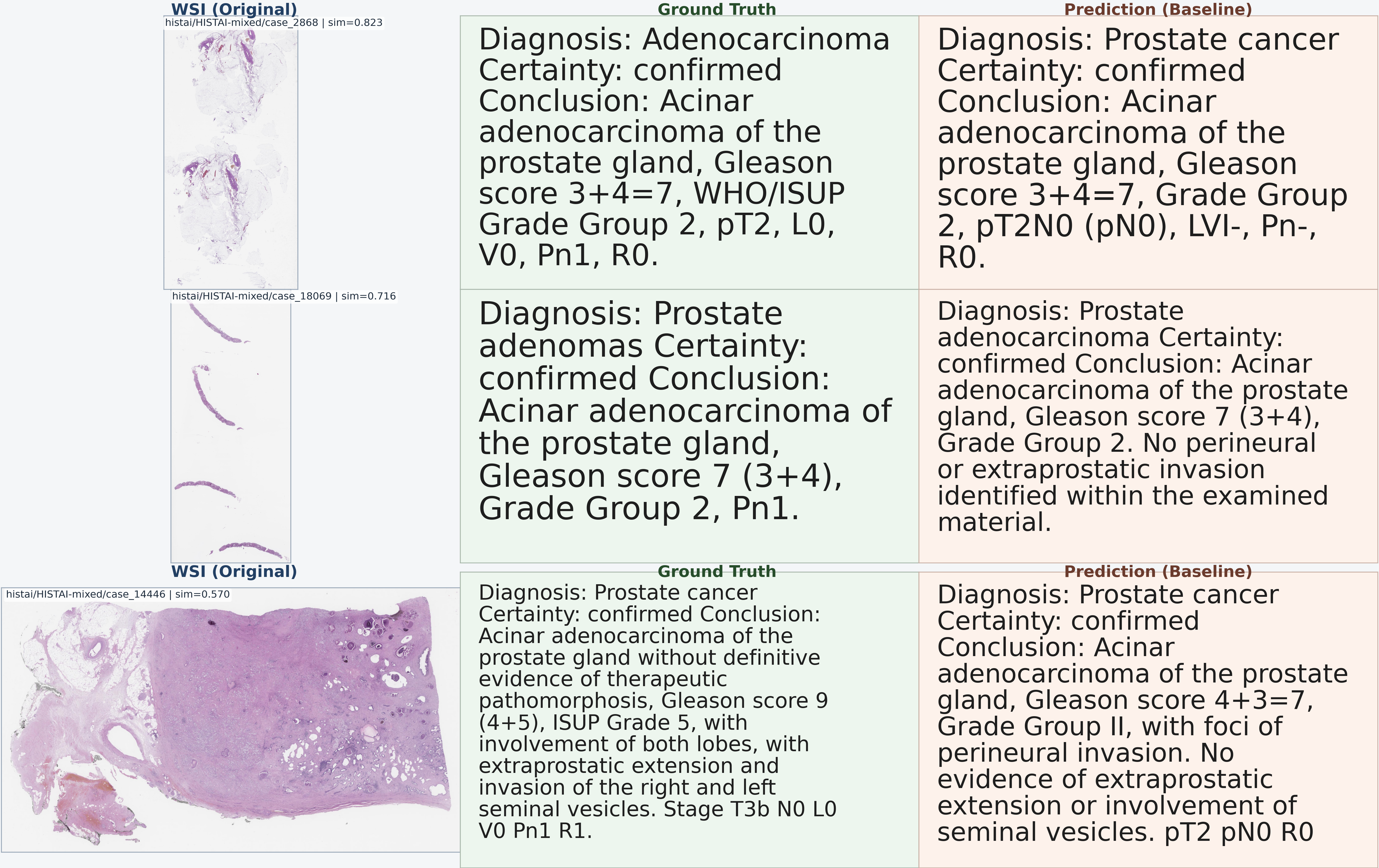 Three Stage 2 examples showing whole-slide image inputs, ground-truth structured reports, and PathoSynVLM baseline predictions.